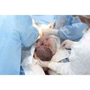  New Baby Being Born during Cesarean Section   Peel and 